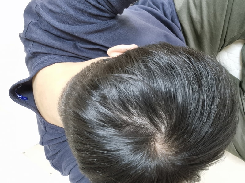미녹시딜 도포에 대하여