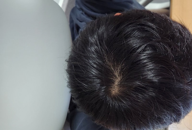 안녕하세요 이거 혹시 탈모인가요?