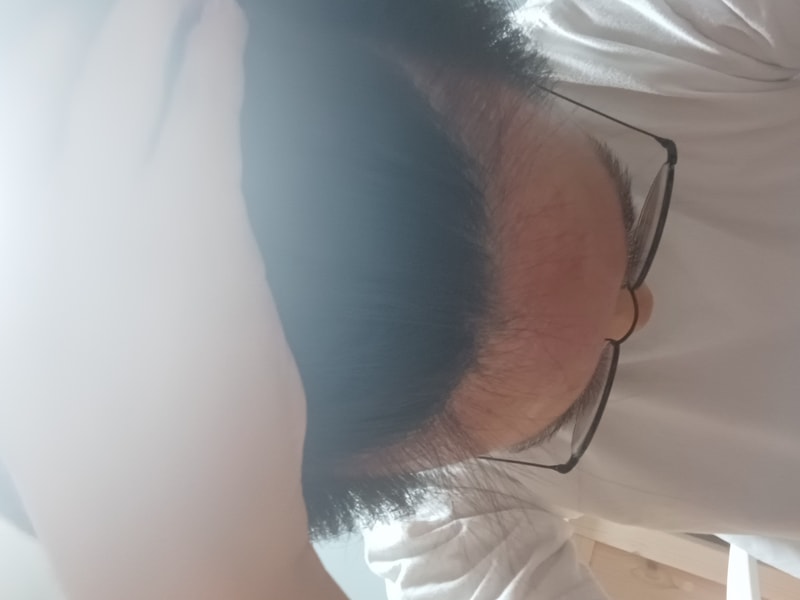 중학교 3학년 탈모인가요?