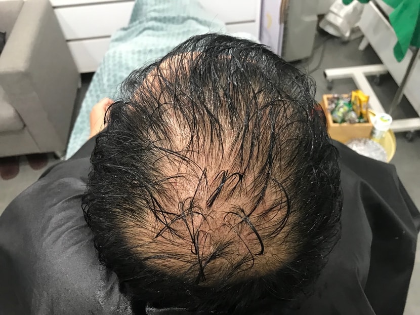 시술전