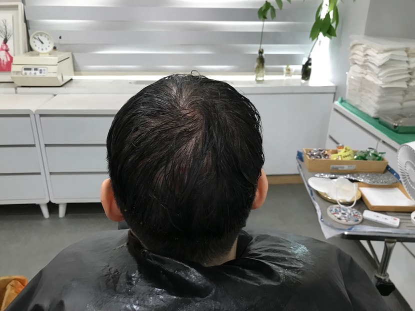 시술전
