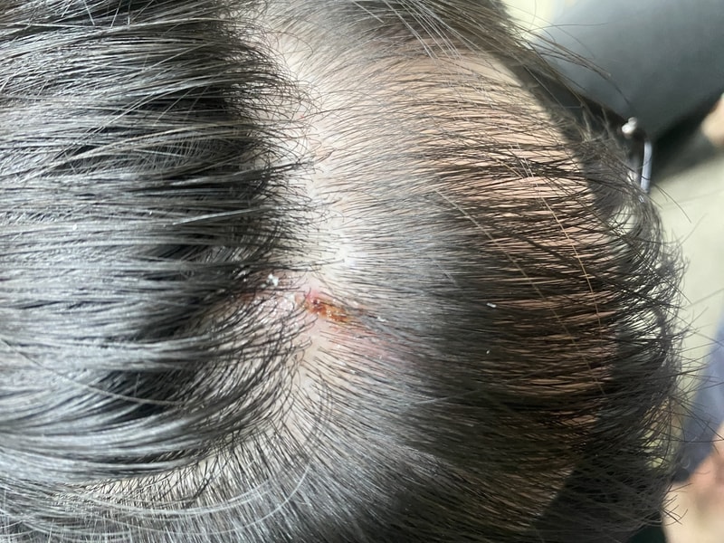 두피 상처 영구탈모 질문