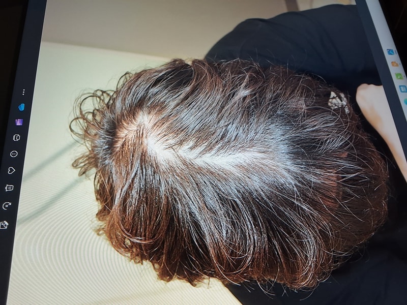 안녕하세요 20살 남자 탈모 질문입니다