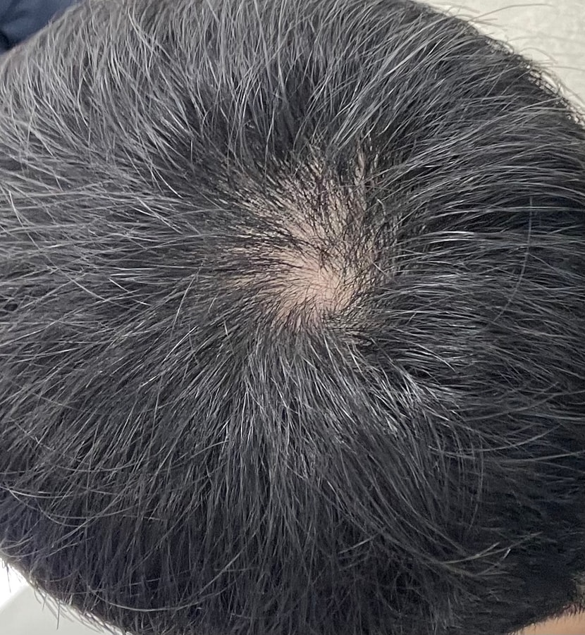 이소티논 1개월 복용후, 머리가 빠지기 시작하는걸 느껴서 피나온 1개월 복용중입니다. 나아지는게 없고 오히려 더 빠지는것 같습니다. 피나온을 계속 복용하는게 맞을지 궁금해서 질문드립니다