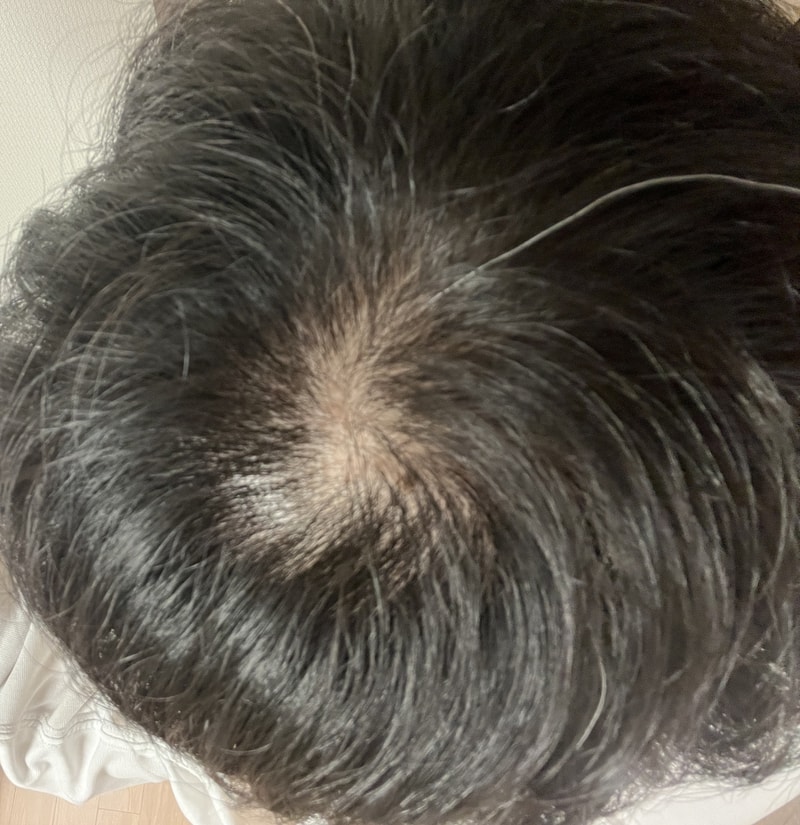 头顶脱发压力太大了ㅠ