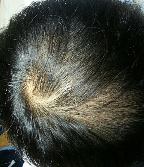 Please estimate the top of the head and M-shaped hair loss.