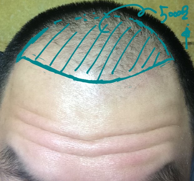 Re: Hair transplant