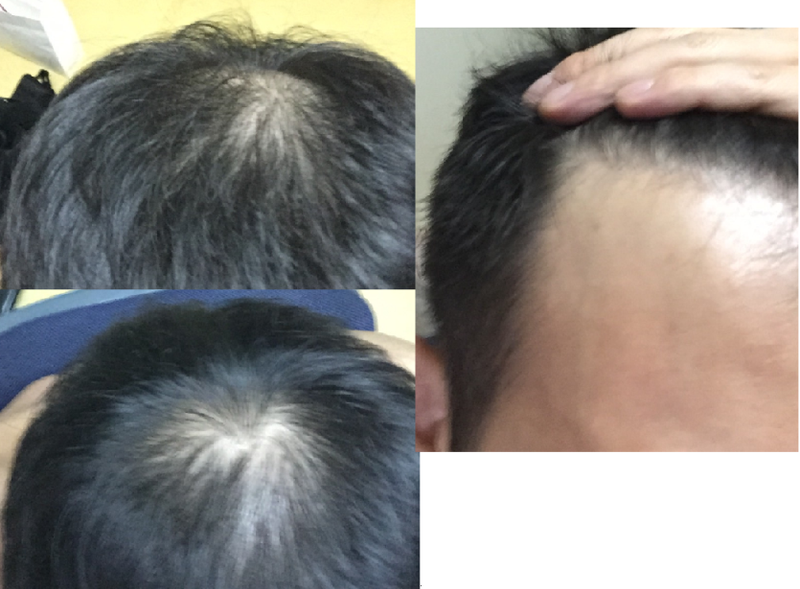 Inquiry about hair transplantation