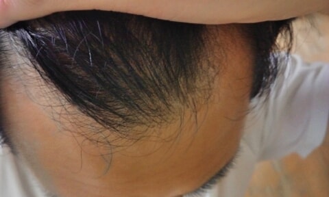 I'd like to inquire about an estimate for a hair transplant.