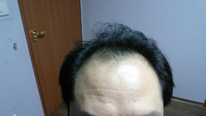 탈모증세(1)