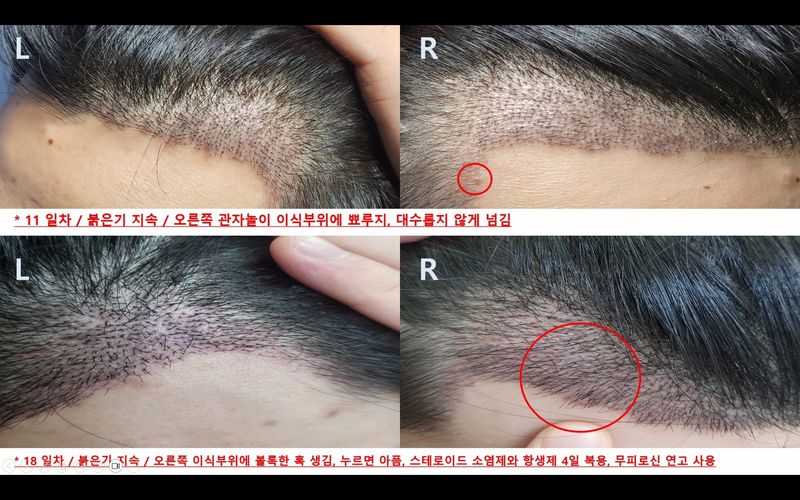 M-shaped cut 1700 hair follicles (3740 hair), 28th day, the dark ages that came quickly, and red scalp ???