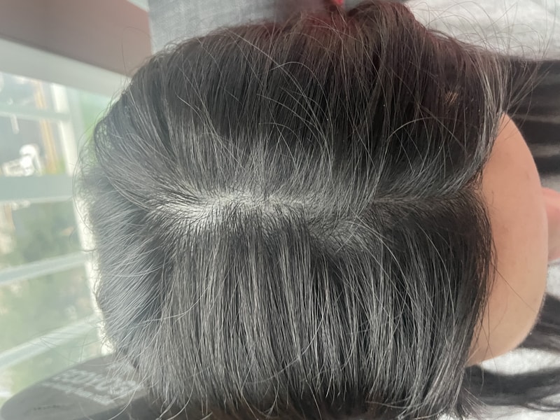 가르마 모발이식