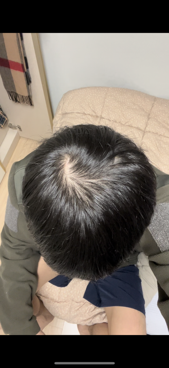 정수리 사진 촬영