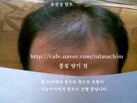 탈모된 사진