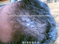 탈모된 사진