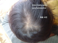 탈모된 사진