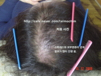 탈모된 사진