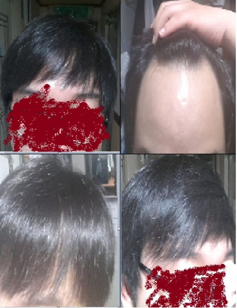 I filled in the M shape of 1500 hair follicles. Slits, cuts, and slits