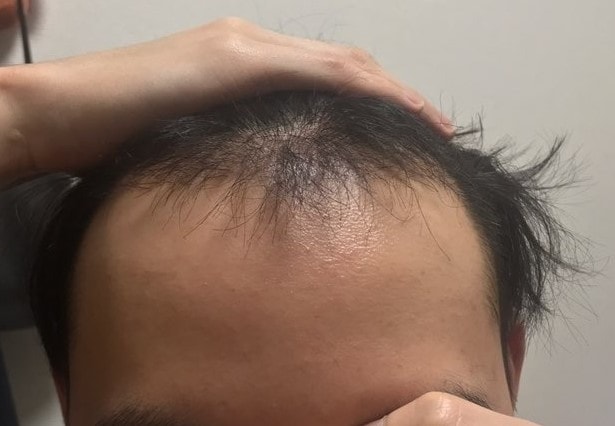 수술후 3개월 정면.jpg