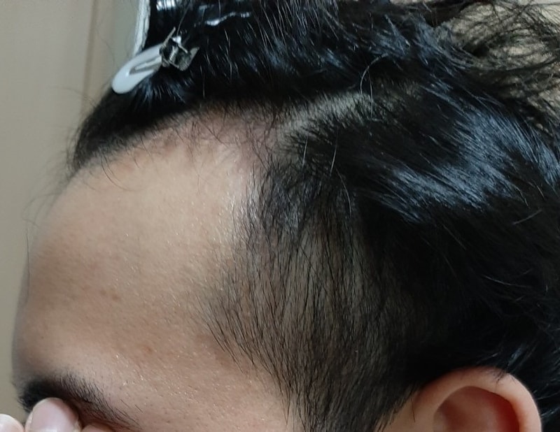 수술전 왼쪽.jpg