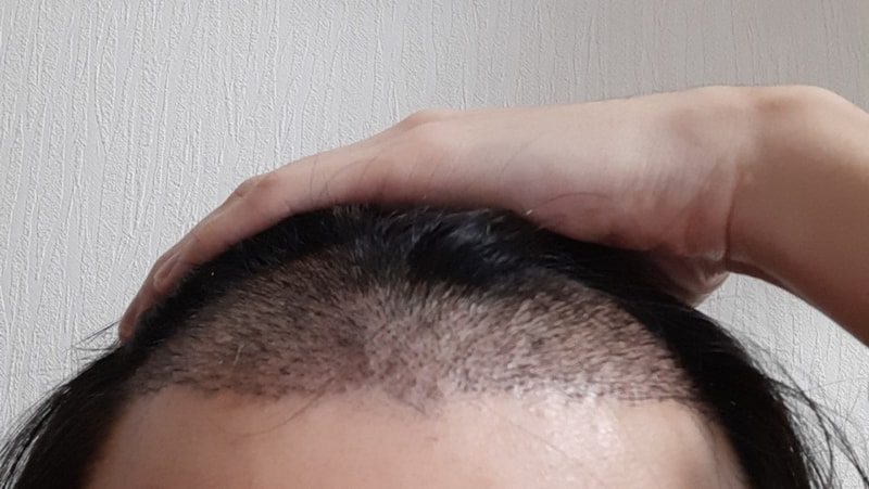딱지제거.jpg