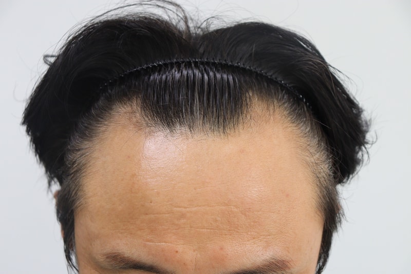 이석용수술전.jpg