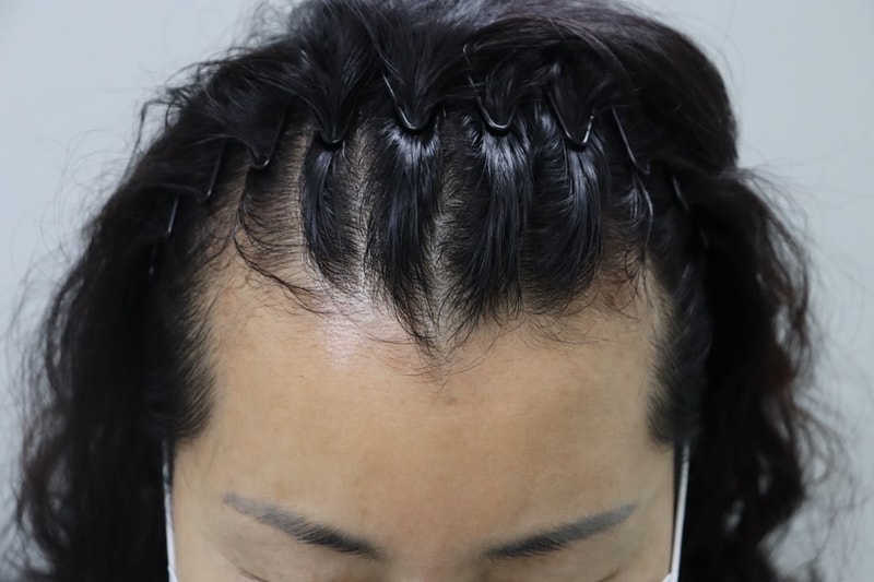변향수수술전.jpg