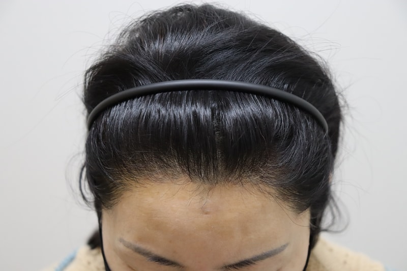 변향수수술후.jpg