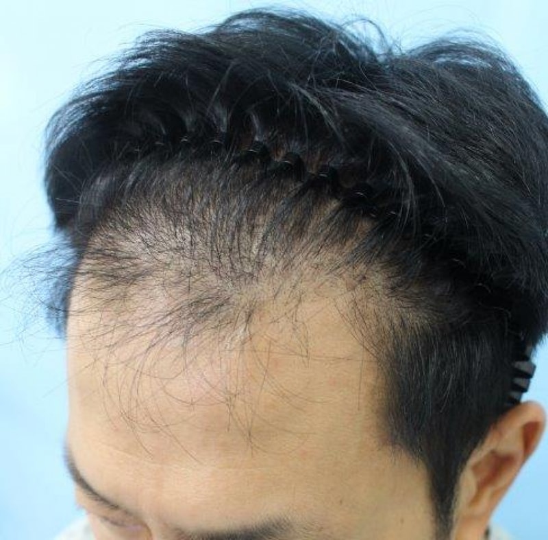 수술전(좌측).jpg