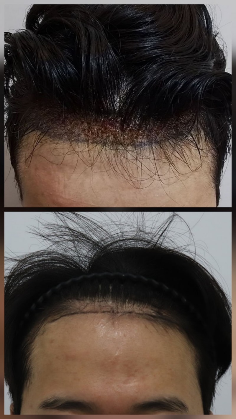 모발이식 포토후기