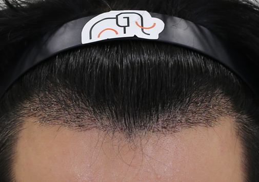 狎鸥亭Mammos Hairine医院2周后半期。