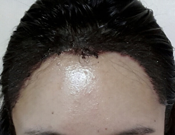 3300 hair incision - 3rd day late