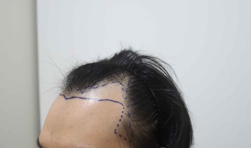 시술전-디자인2.jpg