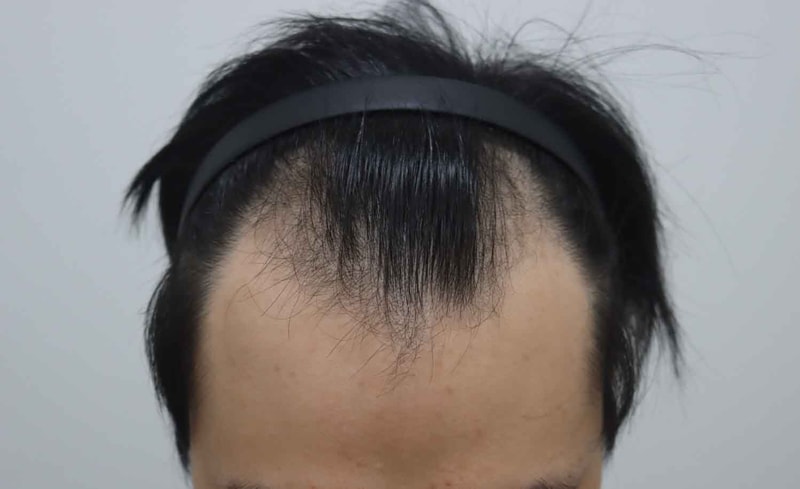 시술전2.jpg