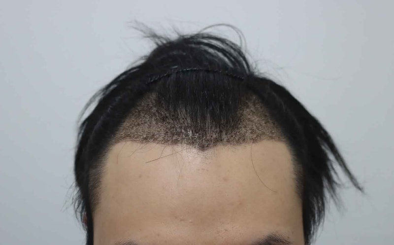 시술후-2주1.jpg