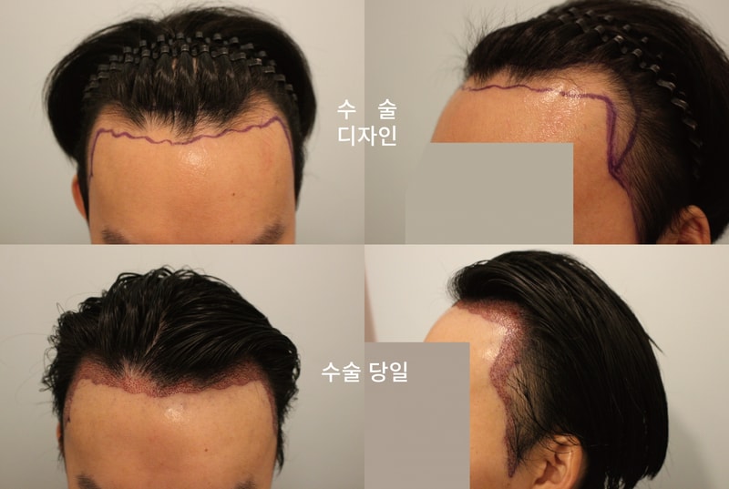 鼻切開2800毛の手術8日目です！