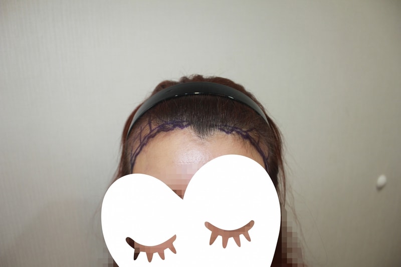 New Hair Hairline Correction (No-Cutting) 3 Months