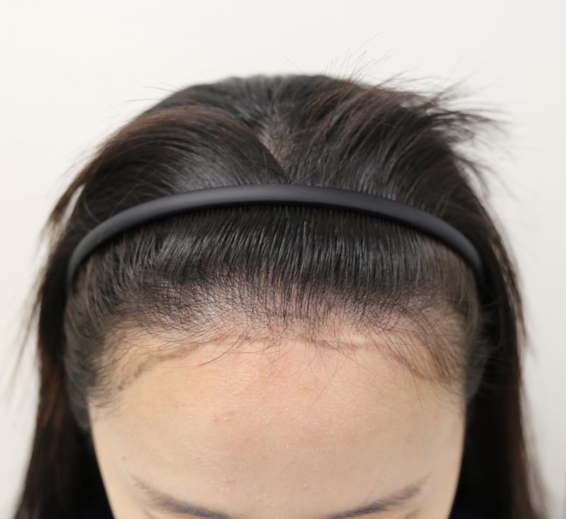 Apgujeong Mammoth Women's Hair Transplantation 10 months have passed. I'm so happy^^