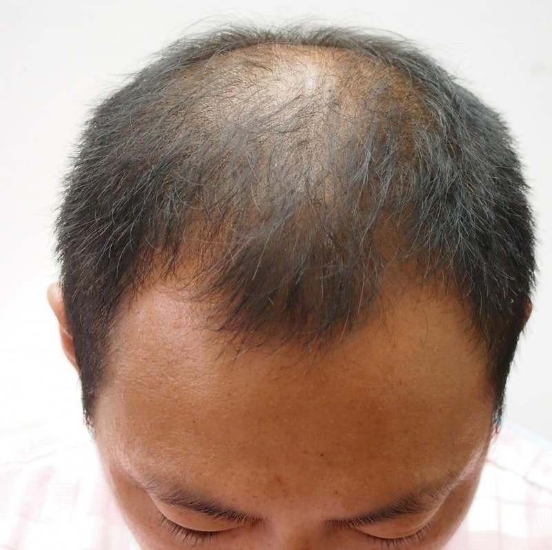 [Four hair] I planted a lot. Non-cut 2000 follicle forehair review.