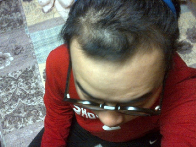 I had surgery in Daegu forehair.