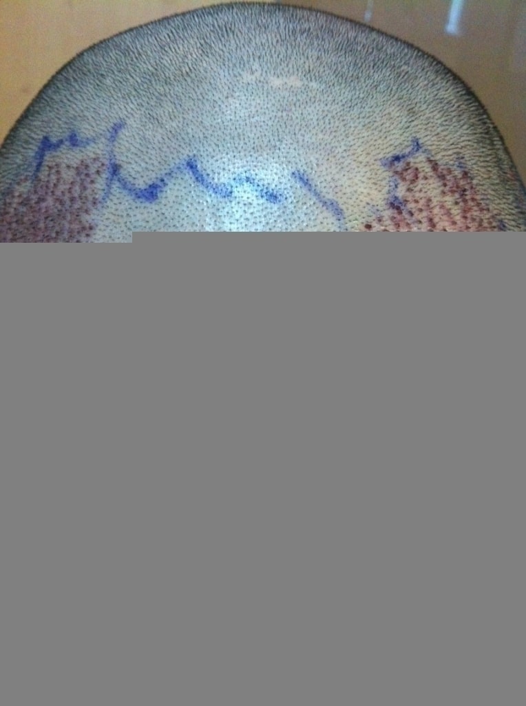 After 7 months of non-intersected hair transplantation in Suseong-gu, Daegu