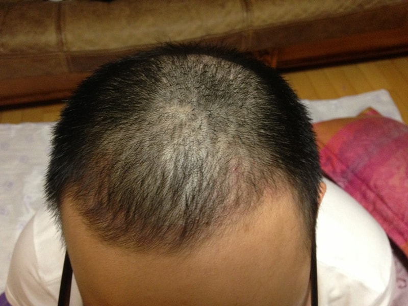 Throw a picture of Daegu forehair around 90 days.