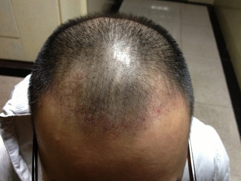 I'm posting a 30-day review of Daegu Pohair's nasal incision.