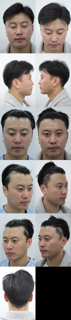 전체수술전후.jpg
