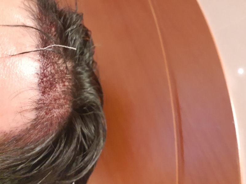 오늘 이식 수술하였습니다 평가부탁드립니다