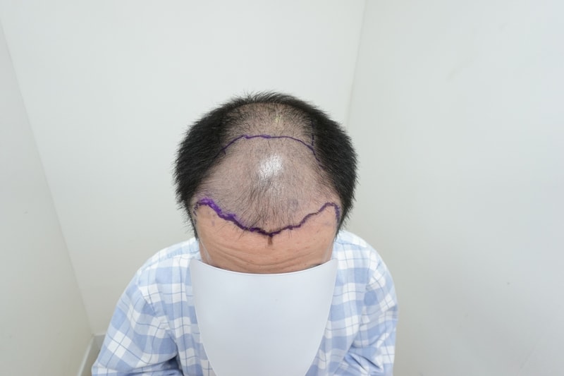 This is the first day of mass hair transplantation at Jarada Clinic.