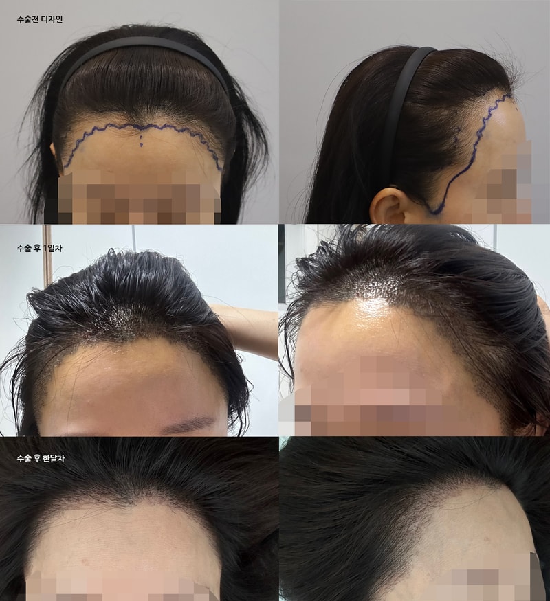 ヘアラインにとても満足しています。