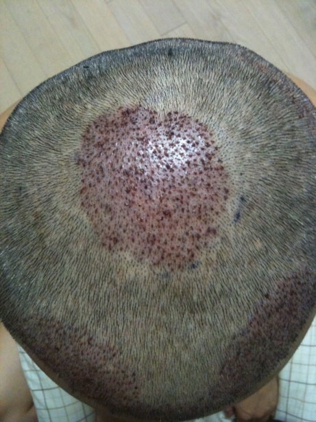 수술후(정수리2).jpg