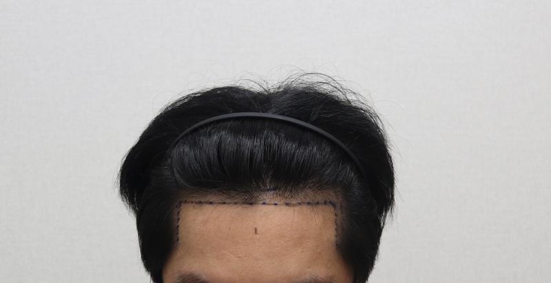 Hair transplant to repair the broadened forehead...