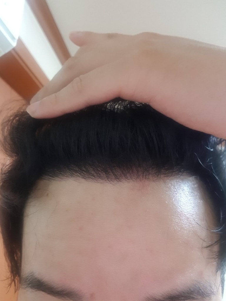 移植9个月左右了。